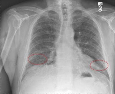 Idiopathic Pulmonary Fibrosis (Ipf) Workup: Laboratory Studies, Imaging  Studies, Other Tests