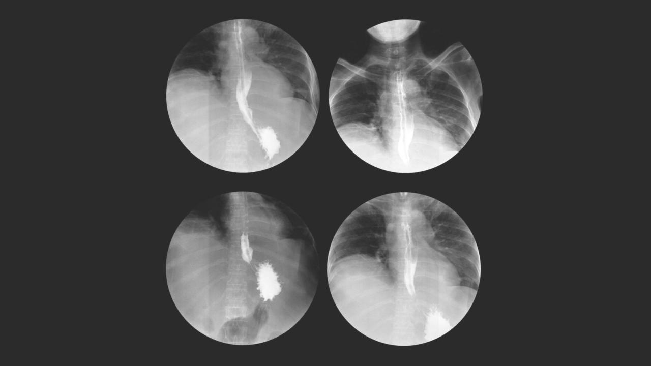 What Is a Barium Swallow Test, and When Is It Used? - GoodRx What Is A Barium Swallow Test, And When Is It Used? - Goodrx